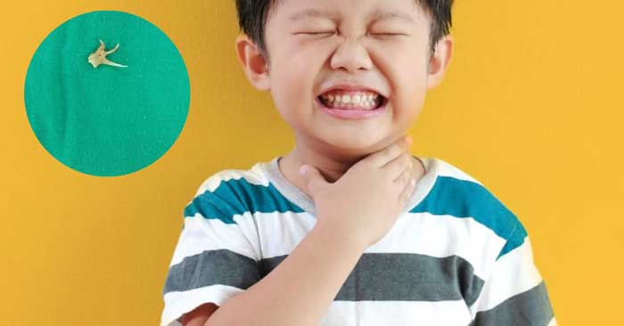 Chữa hóc xương cá cho trẻ nhỏ cần lưu ý gì